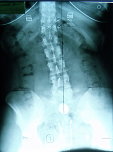 Patient C Before Embrun Chiropractic xray