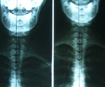Patient D Before and Patient D After embrun chiropractic xray