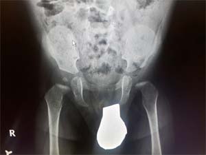 after-hip-joint