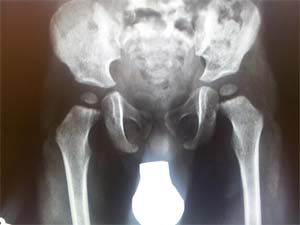 before-hip-joint