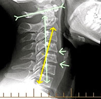 Cervical Curve : Pre Chiropractic Care X-rays
