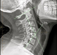 Cervical Curve : Post Chiropractic Care X-Rays 