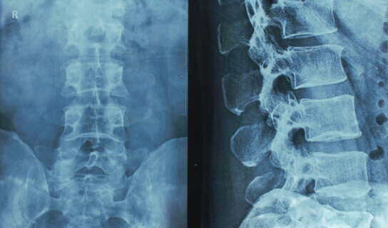 X-Ray of spine