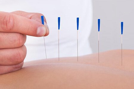 Dry needling