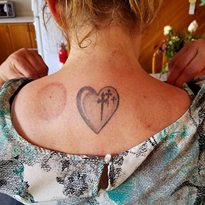 Woman's shoulders after a cupping treatment