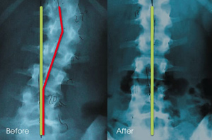 Subluxation Before and After Chiropractic