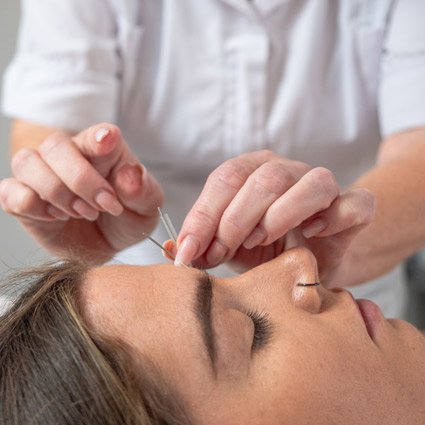 Woman receiving dry needling therapy on her forehead