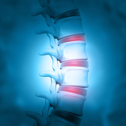 finger pointing at herniated discs