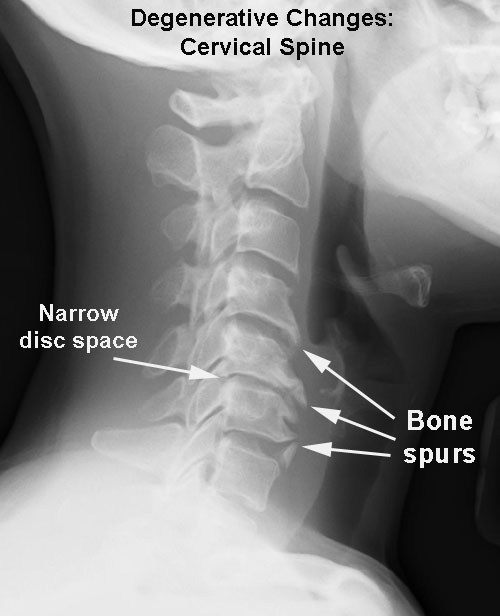X-Ray-image-of-Cervical-Spondylosis