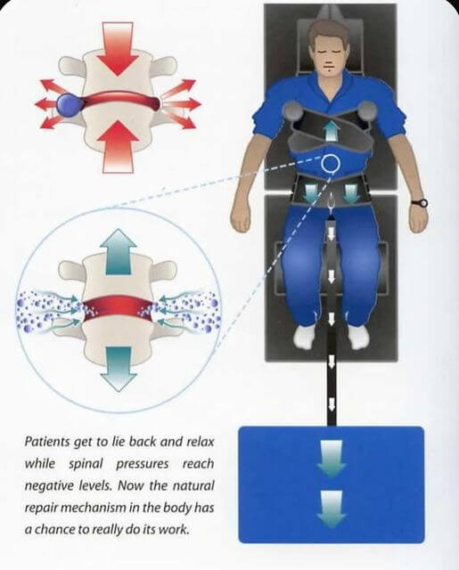 Decompression therapy