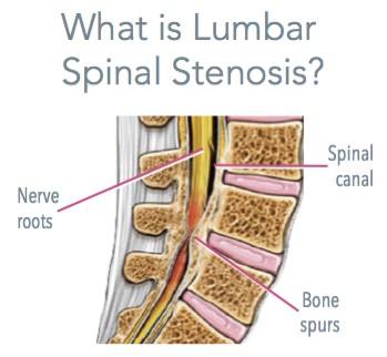 Lumbar Spinal Stenosis Depiction