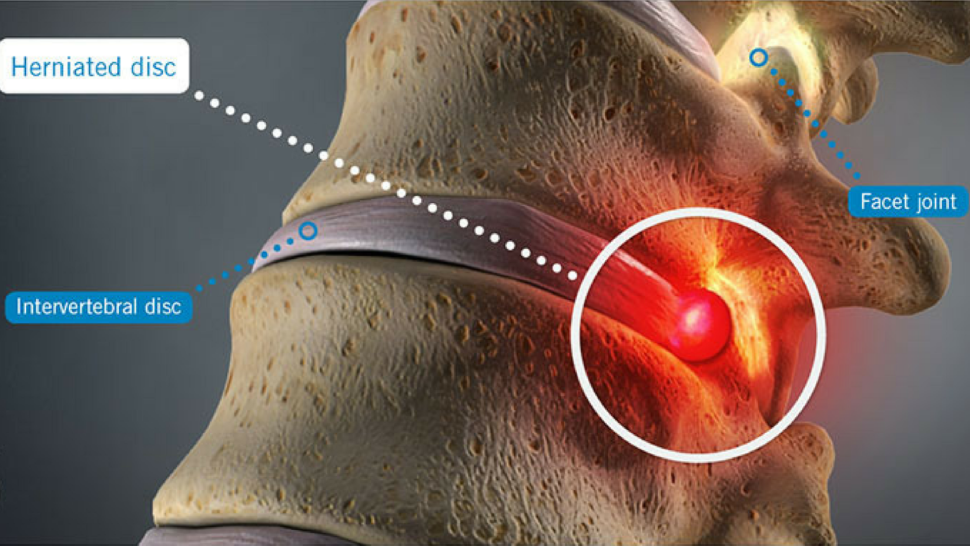 Is it a Herniated Disc, a Bulging Disc, or a Pinched Nerve? - Accent on  Health Chiropractic