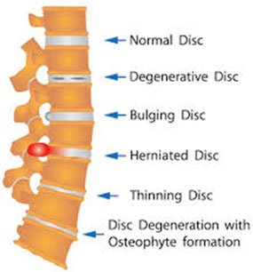 Spinal Decompression Diagram