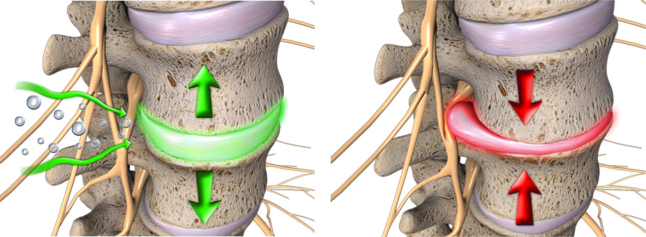 spinal decompression diagram