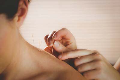 acupuncture-blog-image