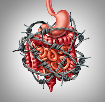 Bowel entangled in barbed wire