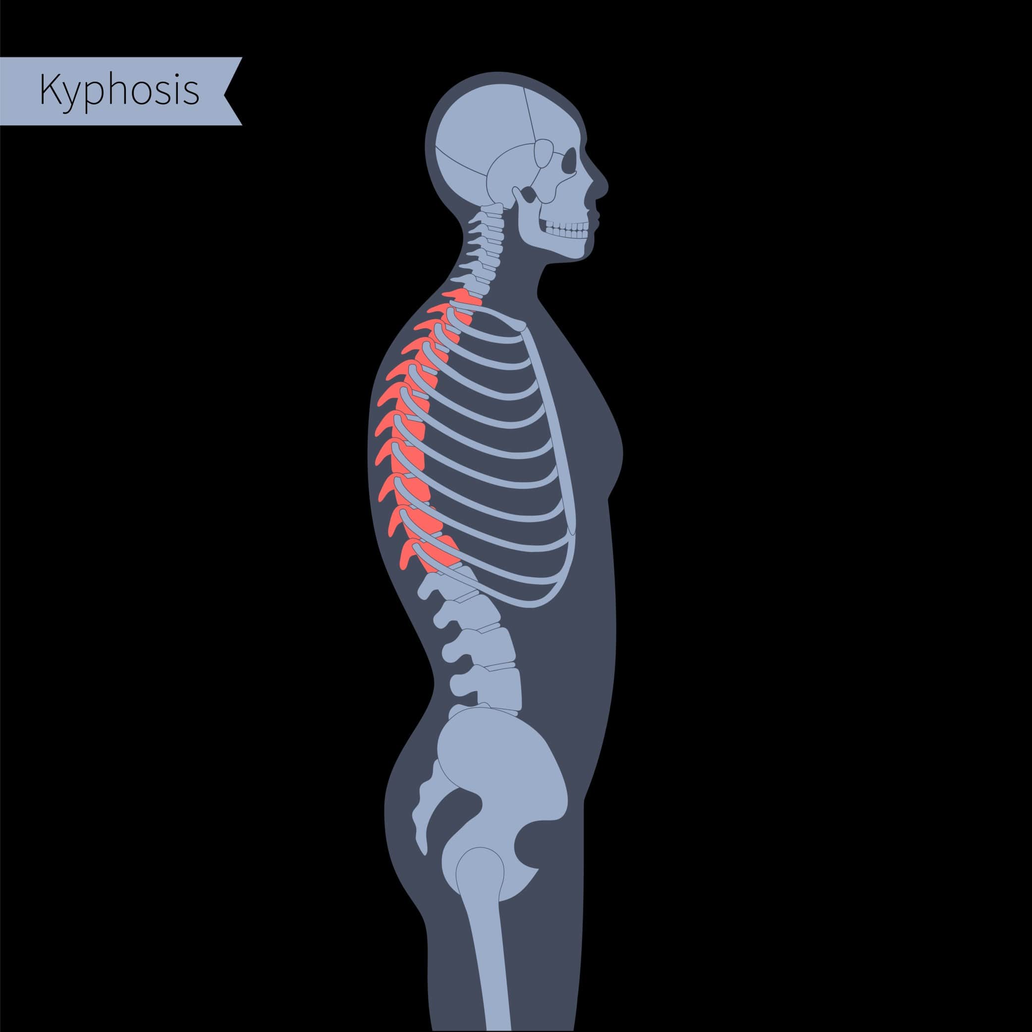 What Is Cervical Kyphosis? Symptoms, Causes, And Treatment