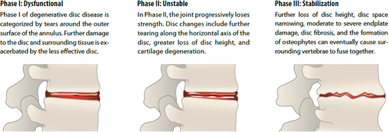 Degenerative Disc Disease Phases