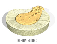 Herniated Disc