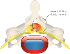 Foraminal Stenosis Illustration