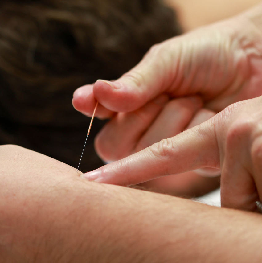 dry needles in persons skin
