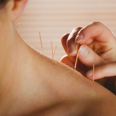 Female patient receiving acupuncture treatment