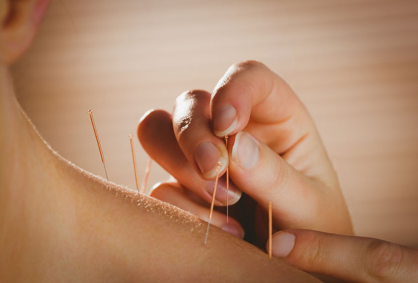 42408081 - young woman getting acupuncture treatment in therapy room