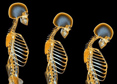 Bad posture: Can chiropractic care reverse bad posture?