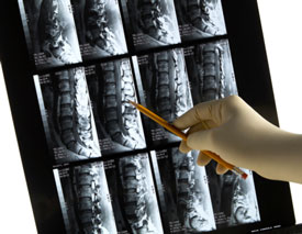 Digital x-ray of the lower spine at Davis Chiropractic in Grand Rapids MN