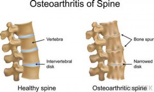 Spine Arthirtis Picture