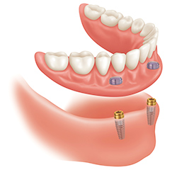 Implant Supported Denture