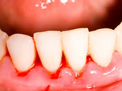 Bleeding gums can be prevented with excellent home care.