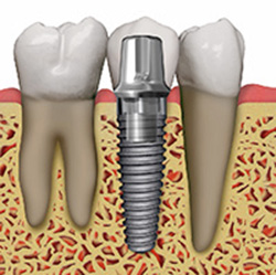 illustration of dental implant Dental Implant in Dracut