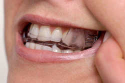 Oral Appliance Therapy Dracut