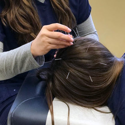 acupuncture needles on a patients scalp