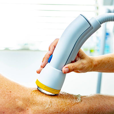 softwave therapy on arm