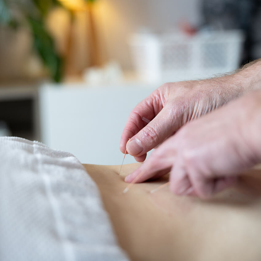 close up of dry needling treatment