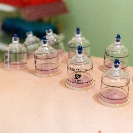 cupping-on-back