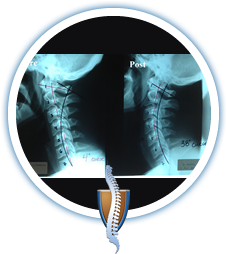 spinal rehabilitation therapy