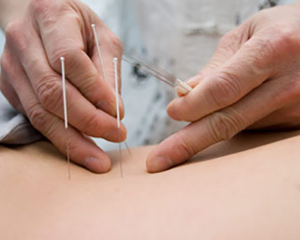 dry needles in a person's skin