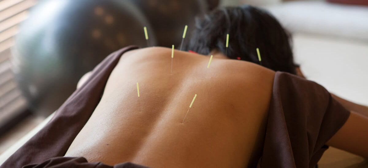 person with dry needles in back