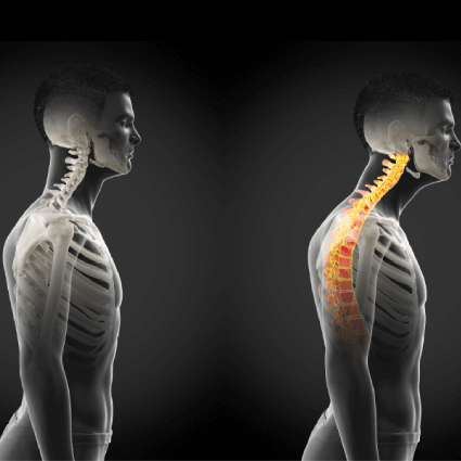 transparent spine overlay good vs bad posture