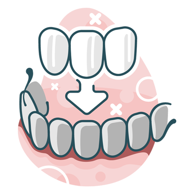 illustration of dental veneers