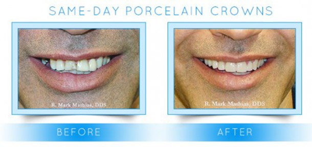 porcelain crowns before and after