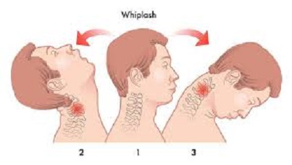 Why Suffer from Whiplash