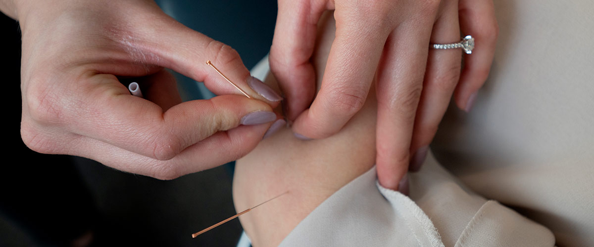 acupuncture on arm