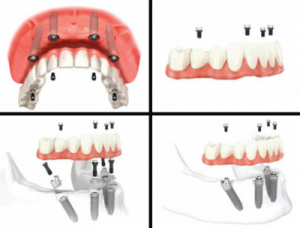 All-on-4 Procedure Illustration 