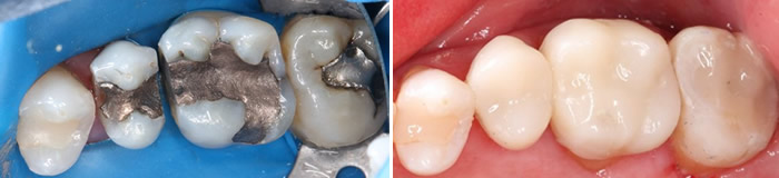 Before After Fillings case 1