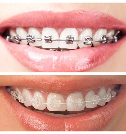 Quick smile braces cost