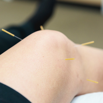 Patient's knee with acupuncture needles